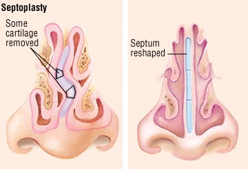 Deviated Septum Disease Reference Guide Drugs Com